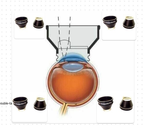 Yag iridectomy - e,