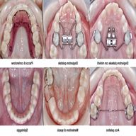 apparecchi ortodontici usato