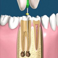 endodonzia usato