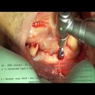 implantologia orale usato